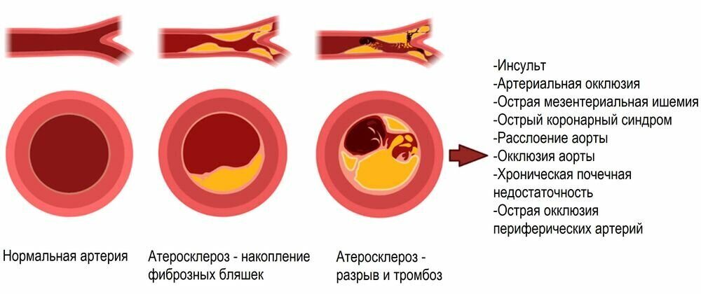 Тромбоз артерии лечение. Атеросклеротическое поражение сосудов. Кальцификация атеросклеротической бляшки. Атеросклероз при кальцификации.